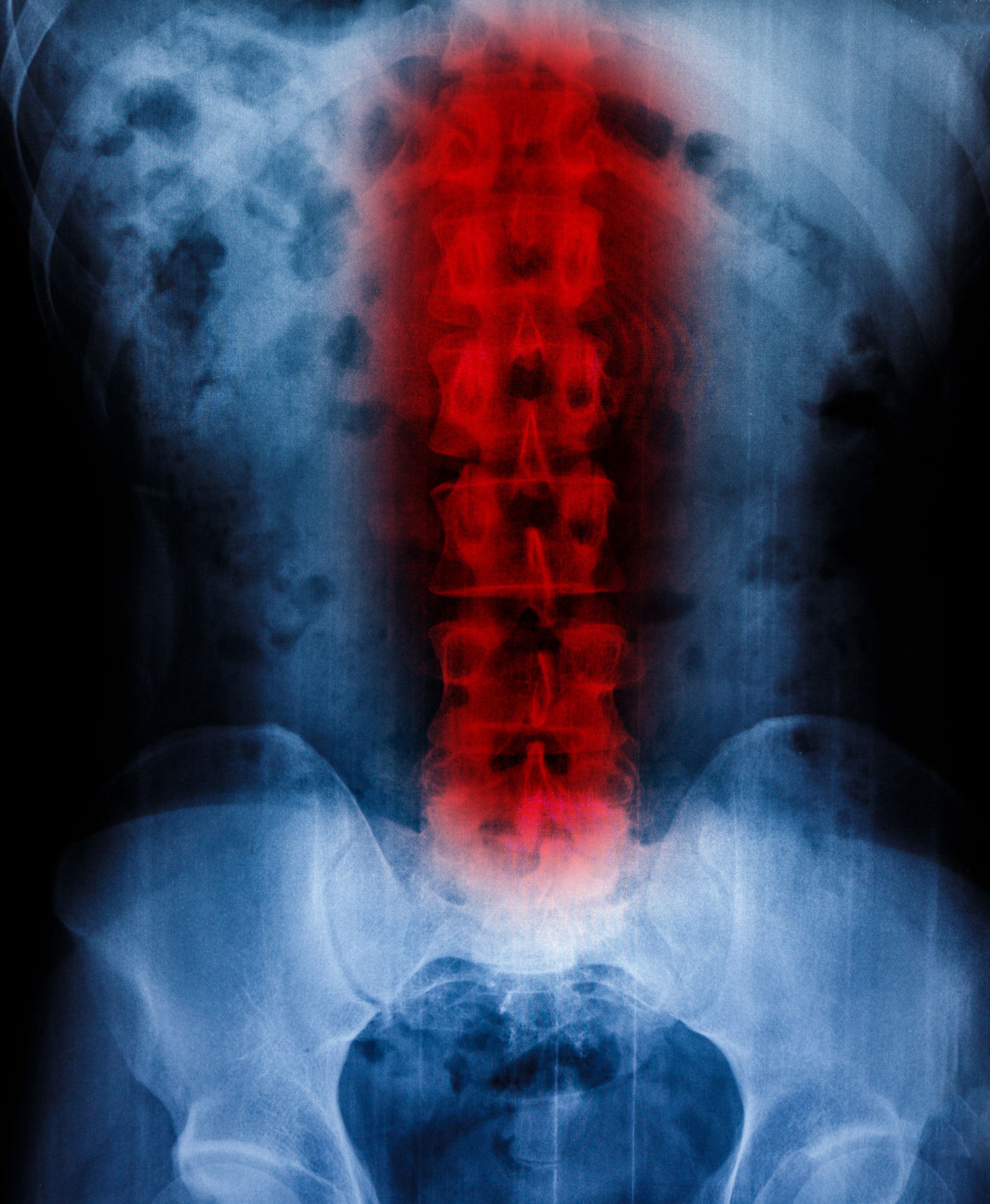 Dangers of Spinal Cord Injuries & How They Affect Quality of Life